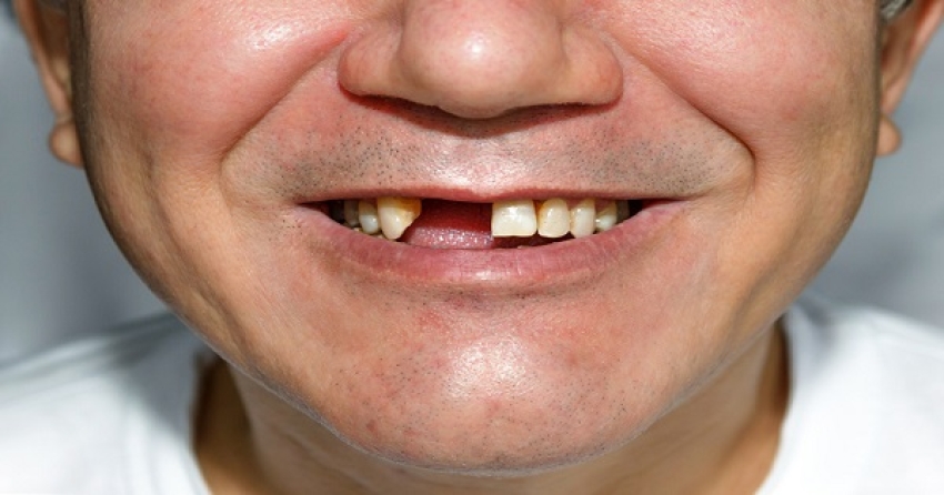 Perdre ses dents fait-il perdre la mémoire ?
