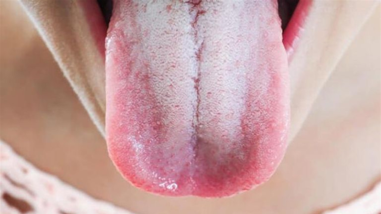 الذكاء الاصطناعي يقرأ اللسان للكشف المبكر عن الأمراض: من السكري إلى سرطان المعدة