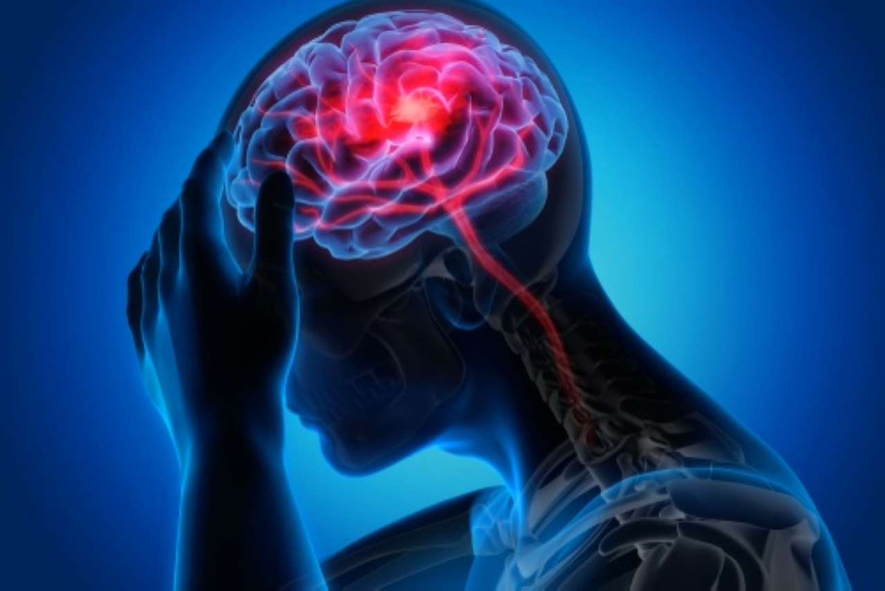 اكتشاف مبشر: دواء تينيكتيبلاز يُظهر وعودًا في علاج السكتة الدماغية