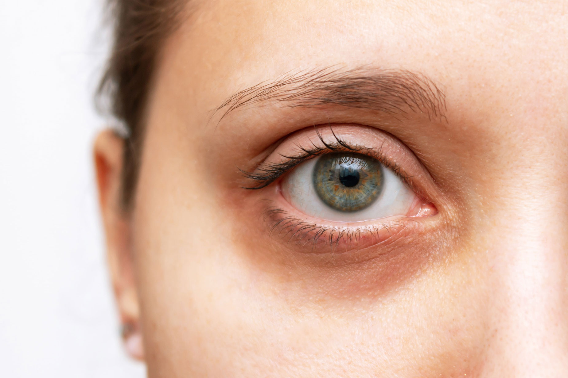 ظهور الهالات السوداء تحت العينين: دلالة على مشكلات صحية قد تكون خطيرة