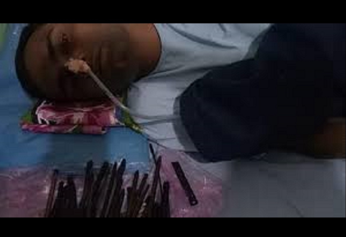 أطباء يستخرجون سكاكين وشفرات حلاقة من أمعاء مريض