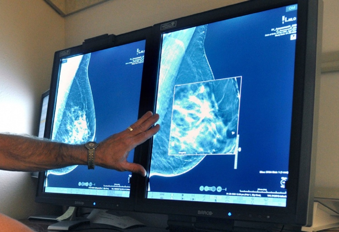 صور الرنين المغناطيسي تقتفي أثر الأورام بالثدي كثيف الأنسجة